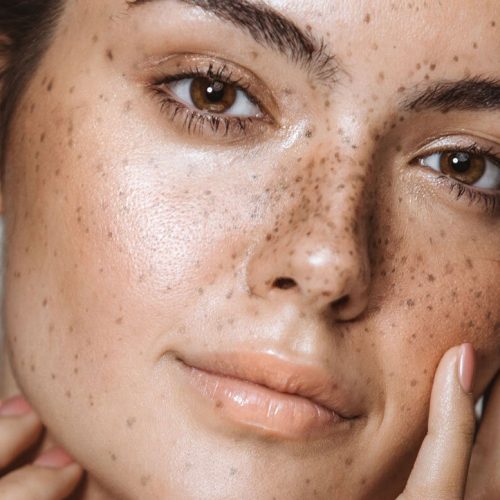 5 Astuces Incontournables pour Prévenir l’Apparition des Taches Pigmentaires